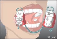 La prothese amovible