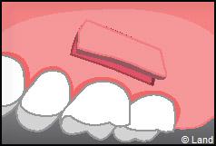 Chirurgie mucogingivale