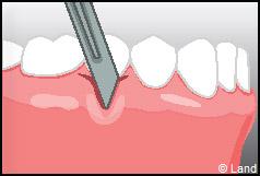 Chirurgie mucogingivale
